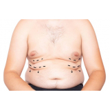 abdominoplastia em homem Tatuapé