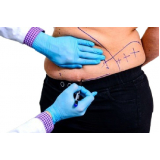 cirurgia de abdominoplastia em âncora Cajamar