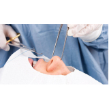 cirurgia de rinoplastia estruturada Zona Leste
