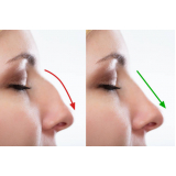 cirurgia para o nariz Biritiba Mirim