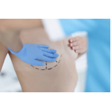 clínica para cirurgia de prótese mamária Vila Prudente