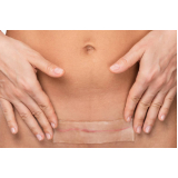 consulta para correção de cicatriz abdominoplastia Parque Burle Max