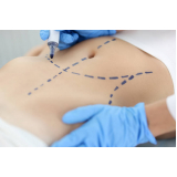 consulta para correção de cicatriz de abdominoplastia Lapa baixa