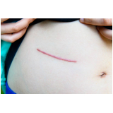 correção de cicatriz abdominoplastia contato Baixada Santista