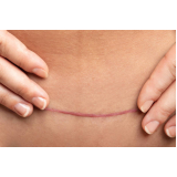 correção de cicatriz de abdominoplastia Peruíbe
