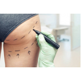gluteoplastia brasileira endereço Tatuapé