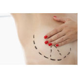 marcar mamoplastia redutora com silicone Barueri