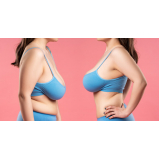 marcar mamoplastia redutora e abdominoplastia Vila Romana