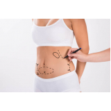 mommy makeover abdominoplastia marcar Real Parque