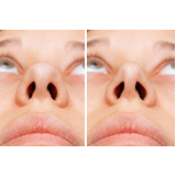 rinoplastia nariz de batata agendar Suzano
